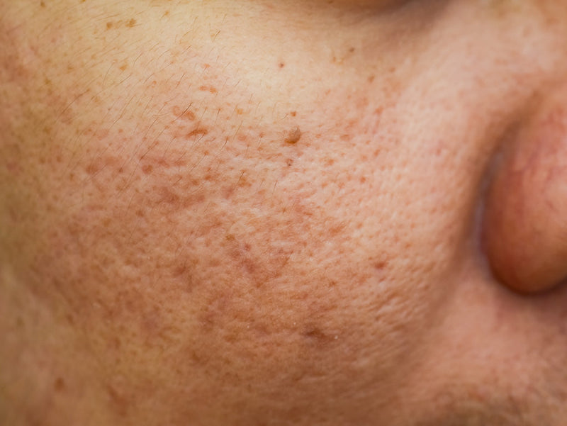 Skincare Routine for Pigmentation