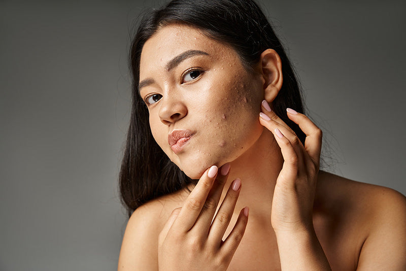 Skincare Routine for Acne-Prone Skin