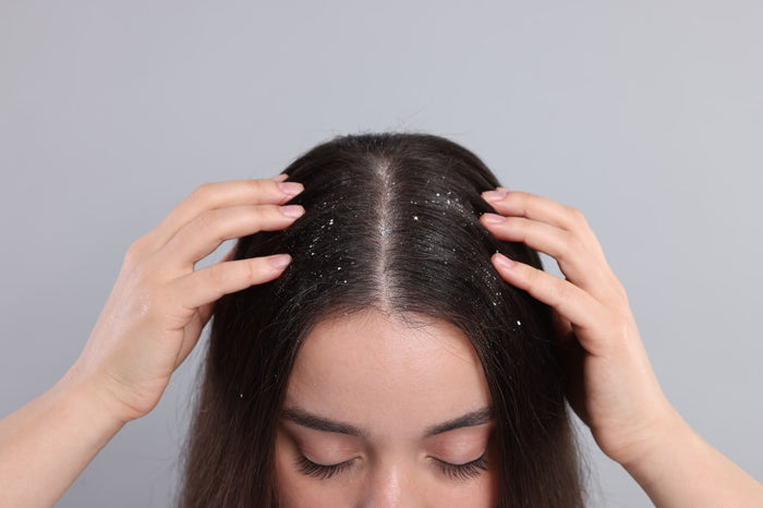 Dandruff — Symptoms, Causes