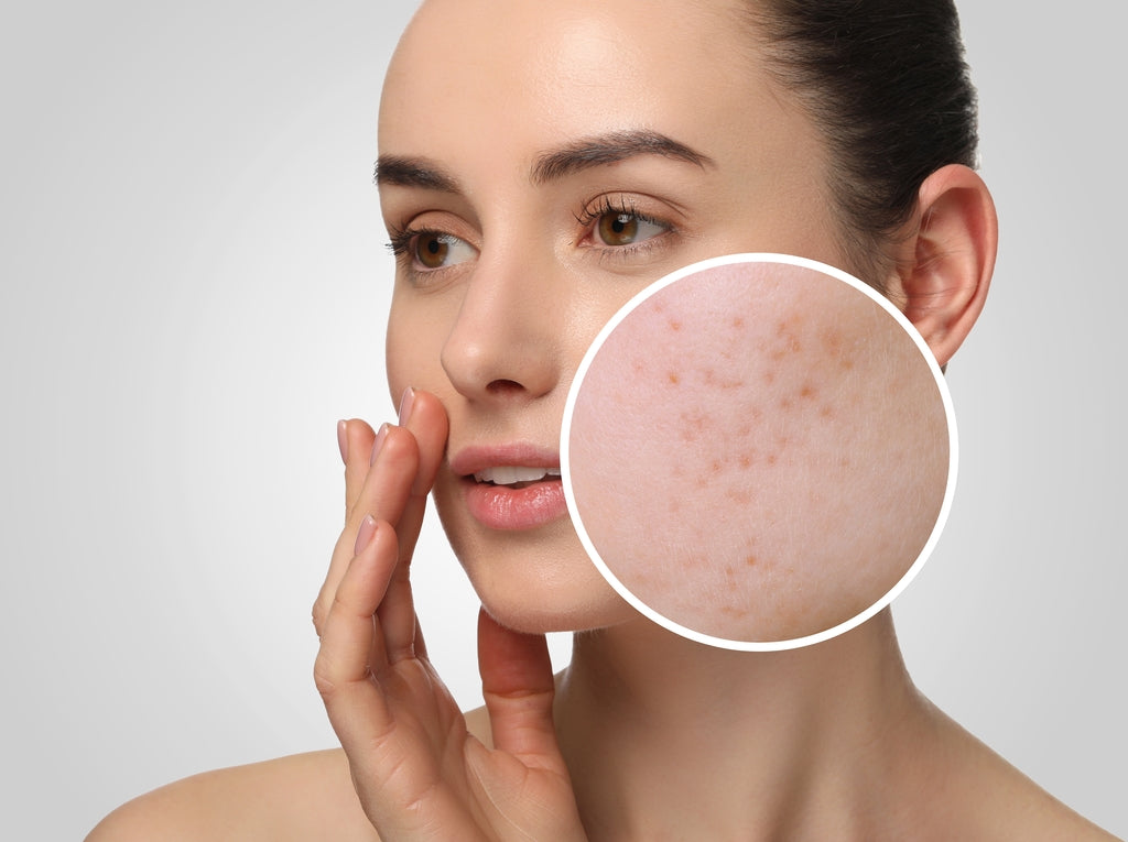 Hormonal Acne: What Is It, Treatment, Causes & Prevention
