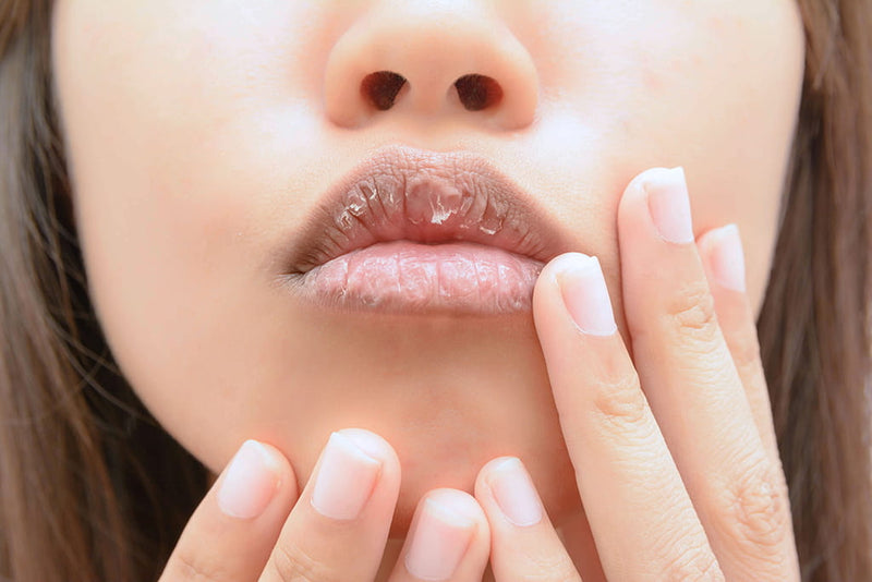 How To Fix Chapped Lips