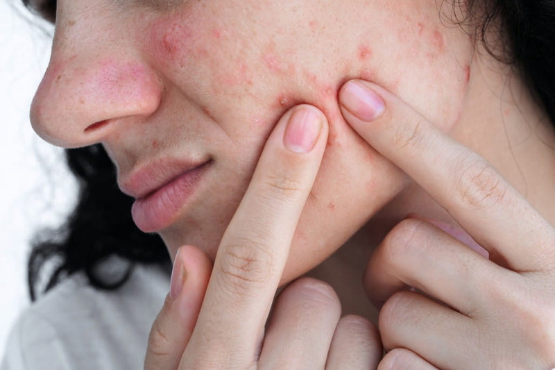How to Get Rid of Acne Scars
