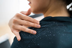 How to Get Rid of Dandruff