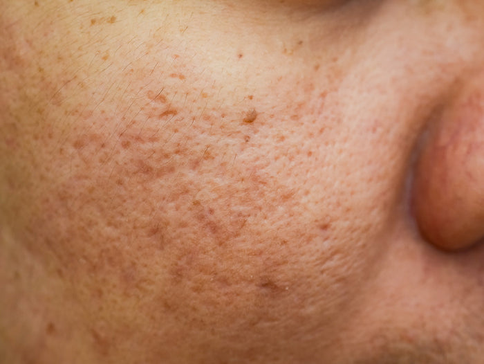 Skincare Routine for Pigmentation