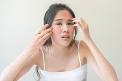 What Foods Cause Acne