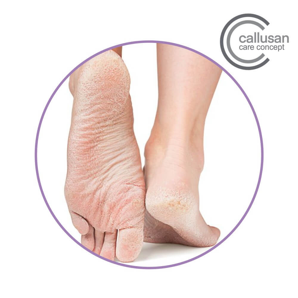 Callusan Extra Mousse – softening cream for heels and feet